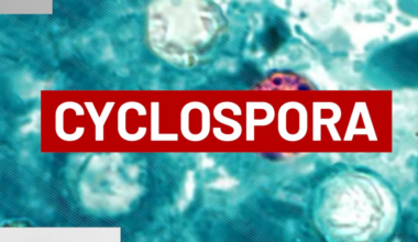 Cyclospora cases confirmed in Big Bend as statewide totals increase