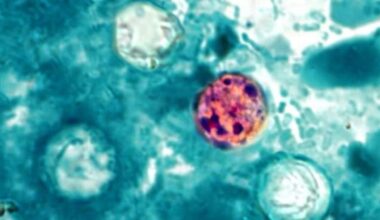 Cyclosporiasis cases in Florida: County-by-county reports