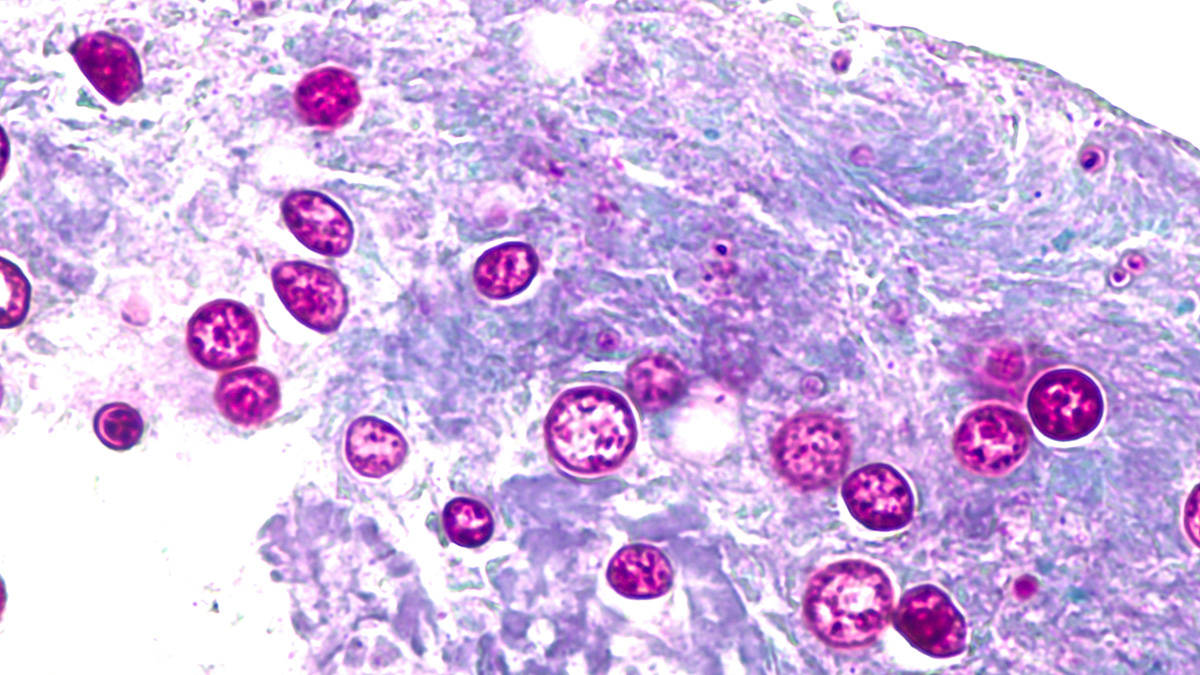 Dozens of cyclosporiasis cases confirmed in Florida including in Miami-Dade and Broward – NBC 6 South Florida