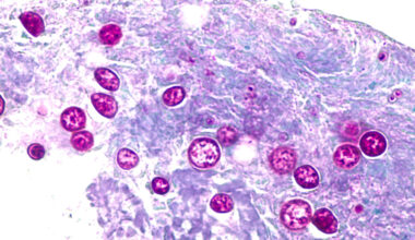 Cases of diarrhea parasite nearly triple in Miami-Dade in a week – NBC 6 South Florida