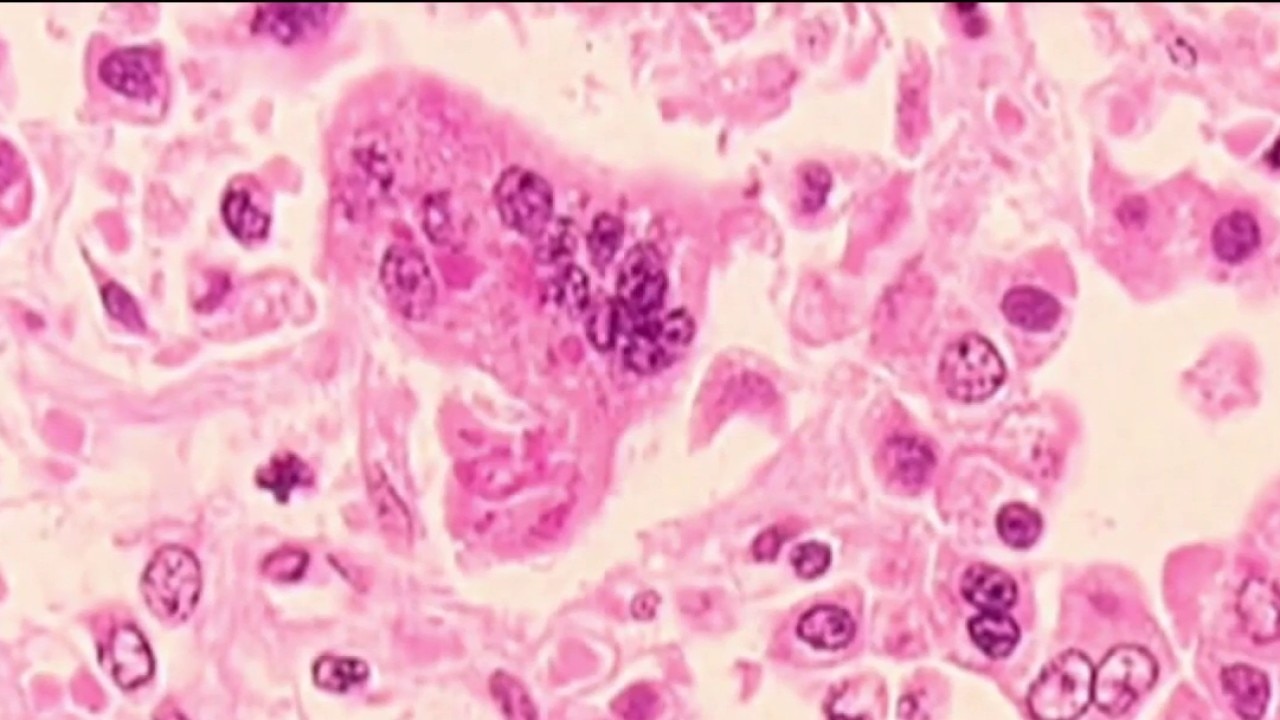 Measles cases break record