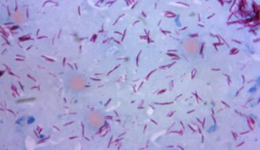 Central Florida Sees Rise in Leprosy Cases