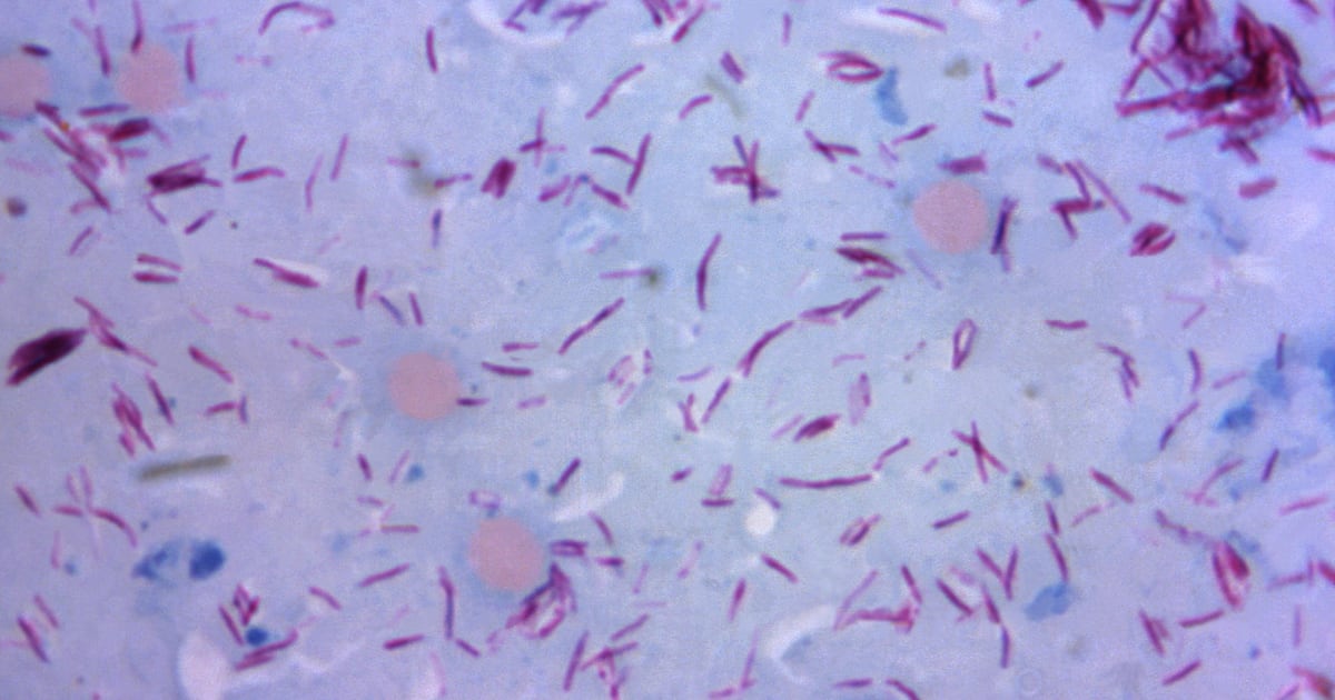 Central Florida Sees Rise in Leprosy Cases
