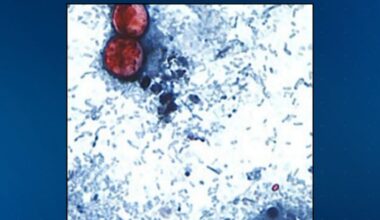 Cyclosporiasis cases surge in US, 190 reported by CDC