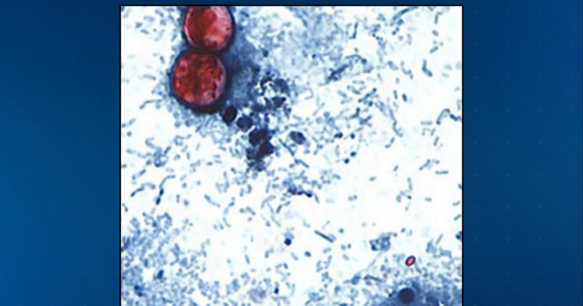 Cyclosporiasis cases surge in US, 190 reported by CDC