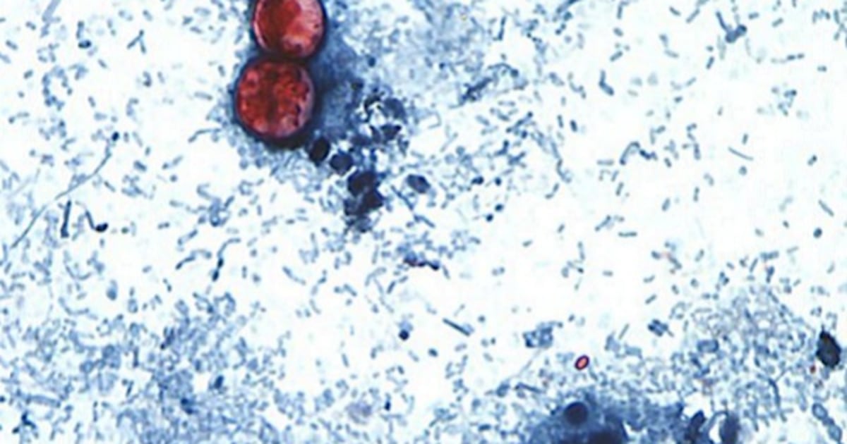 Florida among states reporting cyclosporiasis cases as CDC tracks nationwide increase – Action News Jax