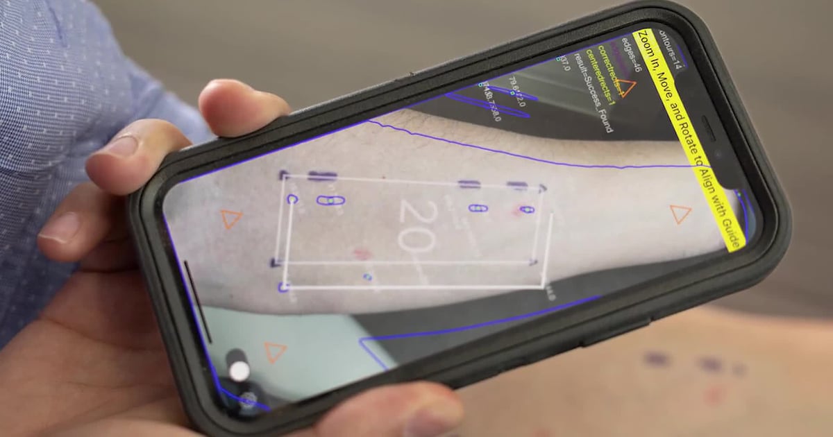 AI could help patients identify skin reactions using phone photos