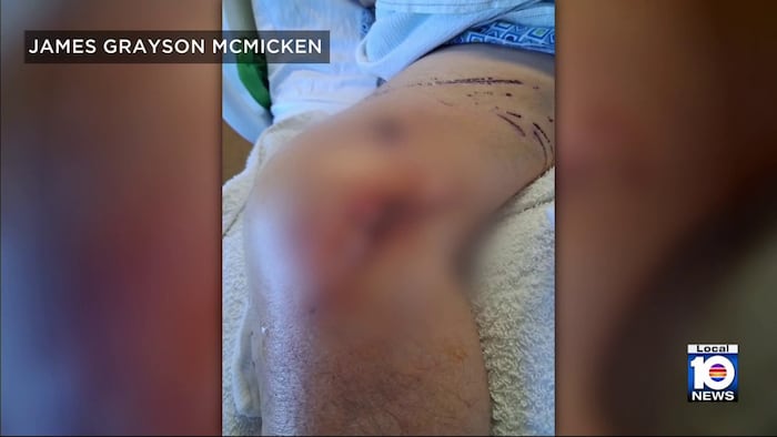 Florida man survives alligator attack during backyard fishing trip
