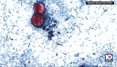 Florida reports several Cyclospora cases as seasonal intestinal illness returns