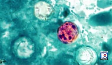Cases of diarrhea-causing parasite rise in Florida, with Miami-Dade leading in confirmed cases