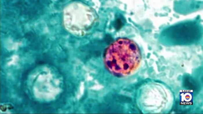 Cases of diarrhea-causing parasite rise in Florida, with Miami-Dade leading in confirmed cases