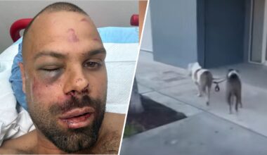 ‘Got my arm badly bit’: Man recovering after being attacked by 2 pit bulls in Wynwood – NBC 6 South Florida