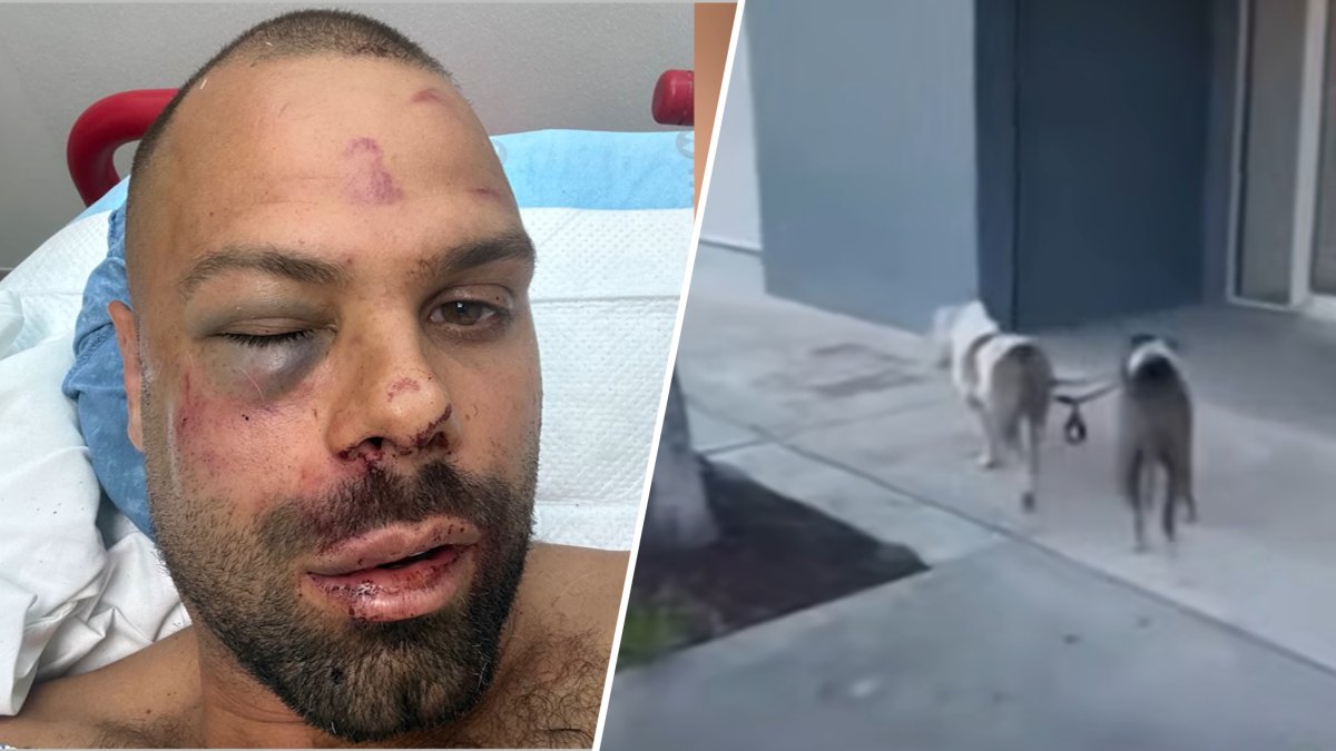 ‘Got my arm badly bit’: Man recovering after being attacked by 2 pit bulls in Wynwood – NBC 6 South Florida