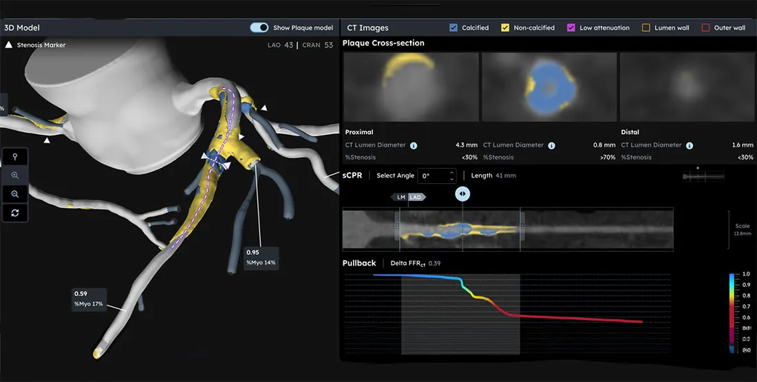 Screenshot of the Heartflow PCI Navigator platform showing a three-dimensional model of coronary arteries alongside CT imaging data, plaque analysis, vessel measurements and blood flow metrics used to evaluate coronary artery disease and plan interventional procedures.