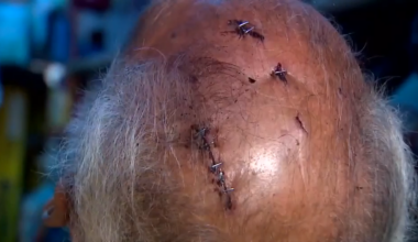 76-year-old gets 7 staples in head after being attacked by man with rusty lawnmower blade in Liberty City - WSVN 7News | Miami News, Weather, Sports
