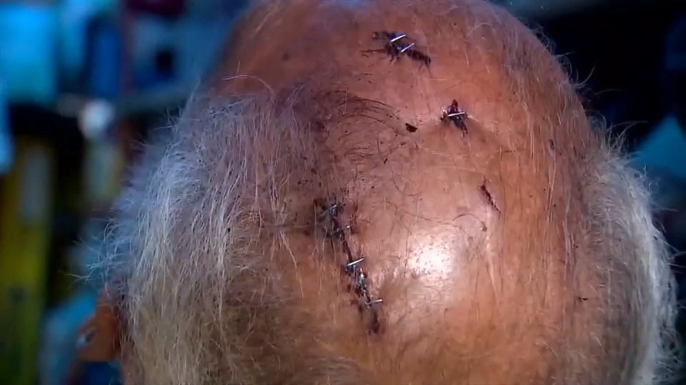 76-year-old gets 7 staples in head after being attacked by man with rusty lawnmower blade in Liberty City - WSVN 7News | Miami News, Weather, Sports