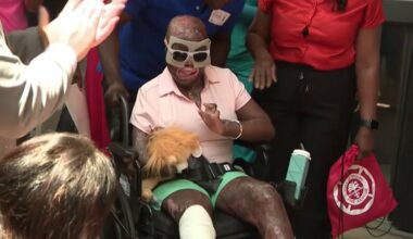 Girl severely burned in crash gets emotional sendoff from Holtz Children’s Hospital – NBC 6 South Florida