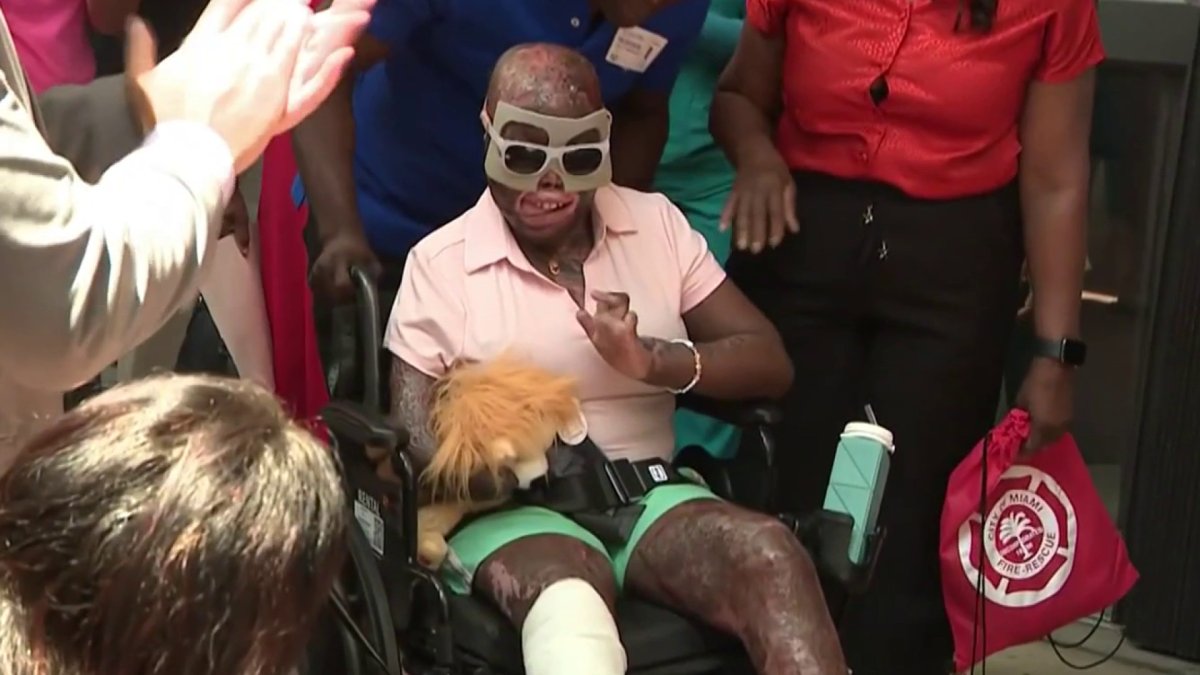 Girl severely burned in crash gets emotional sendoff from Holtz Children’s Hospital – NBC 6 South Florida