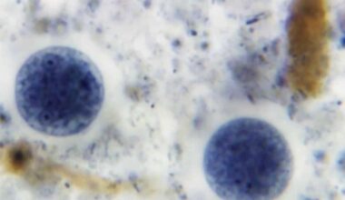Cyclosporiasis cases rise in Florida as testing remains costly and limited