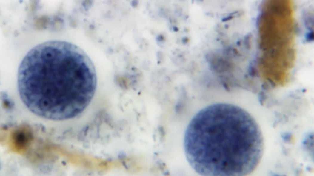 Cyclosporiasis cases rise in Florida as testing remains costly and limited