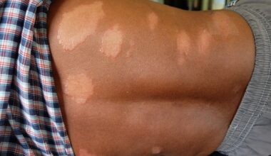 Leprosy Cases On Rise In FL, Could Be Caused By Common Animal, Experts Say