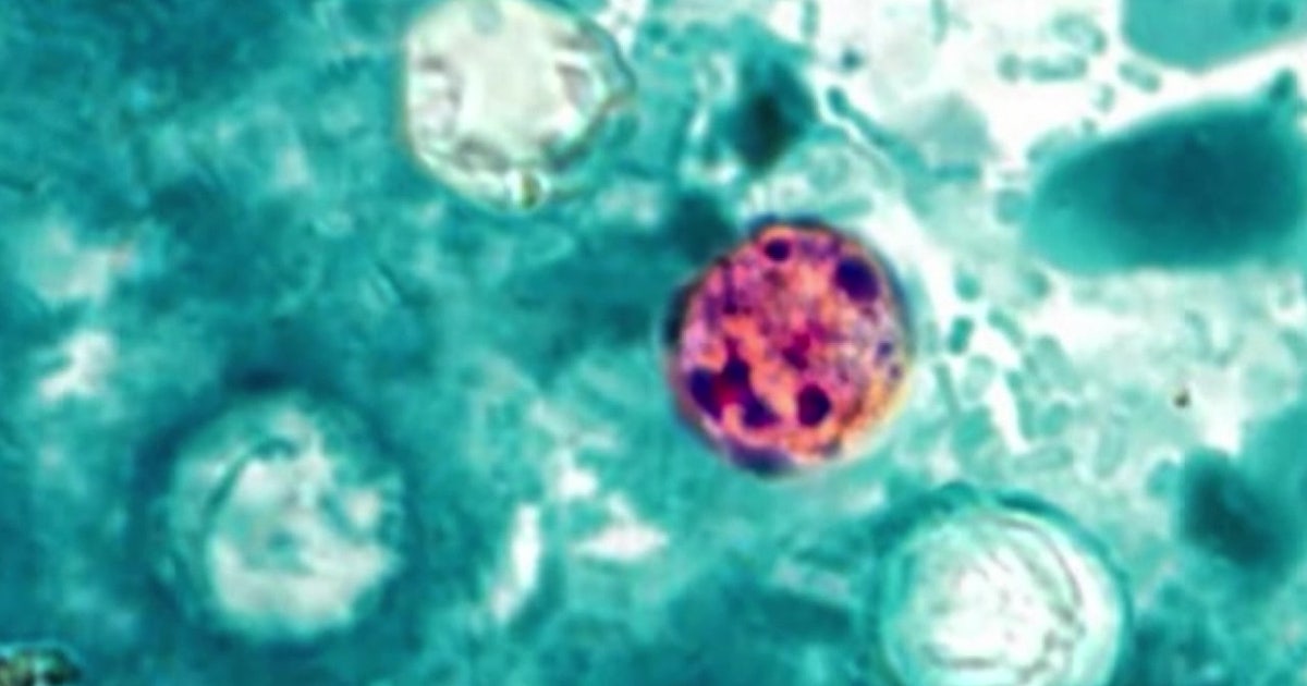 Florida Cyclosporiasis cases rise to 460: Here’s a county-by-county breakdown