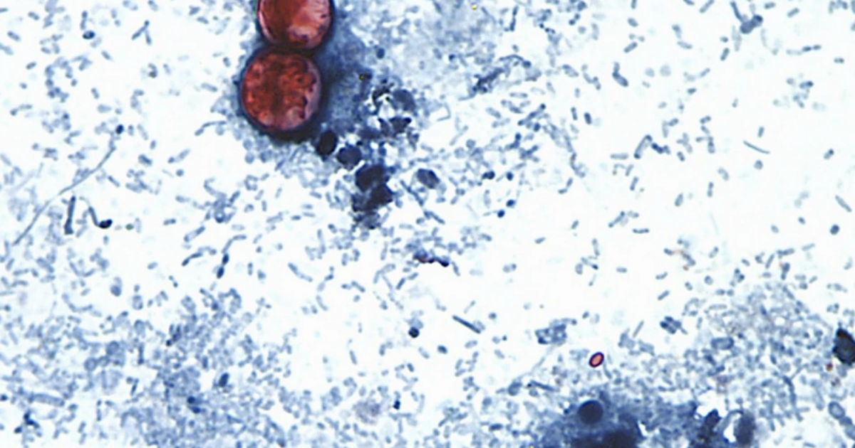 FDA declares cyclospora outbreak over; six cases in Charlotte County | Port Charlotte News