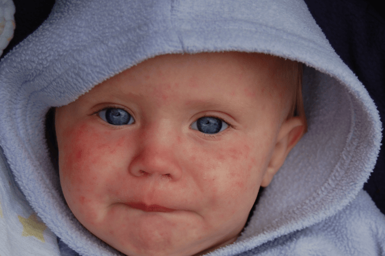 a child with measles