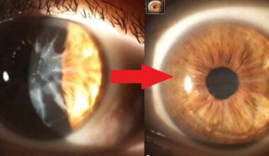 Before and after photos of a repaired cornea using LaZrPlastique.