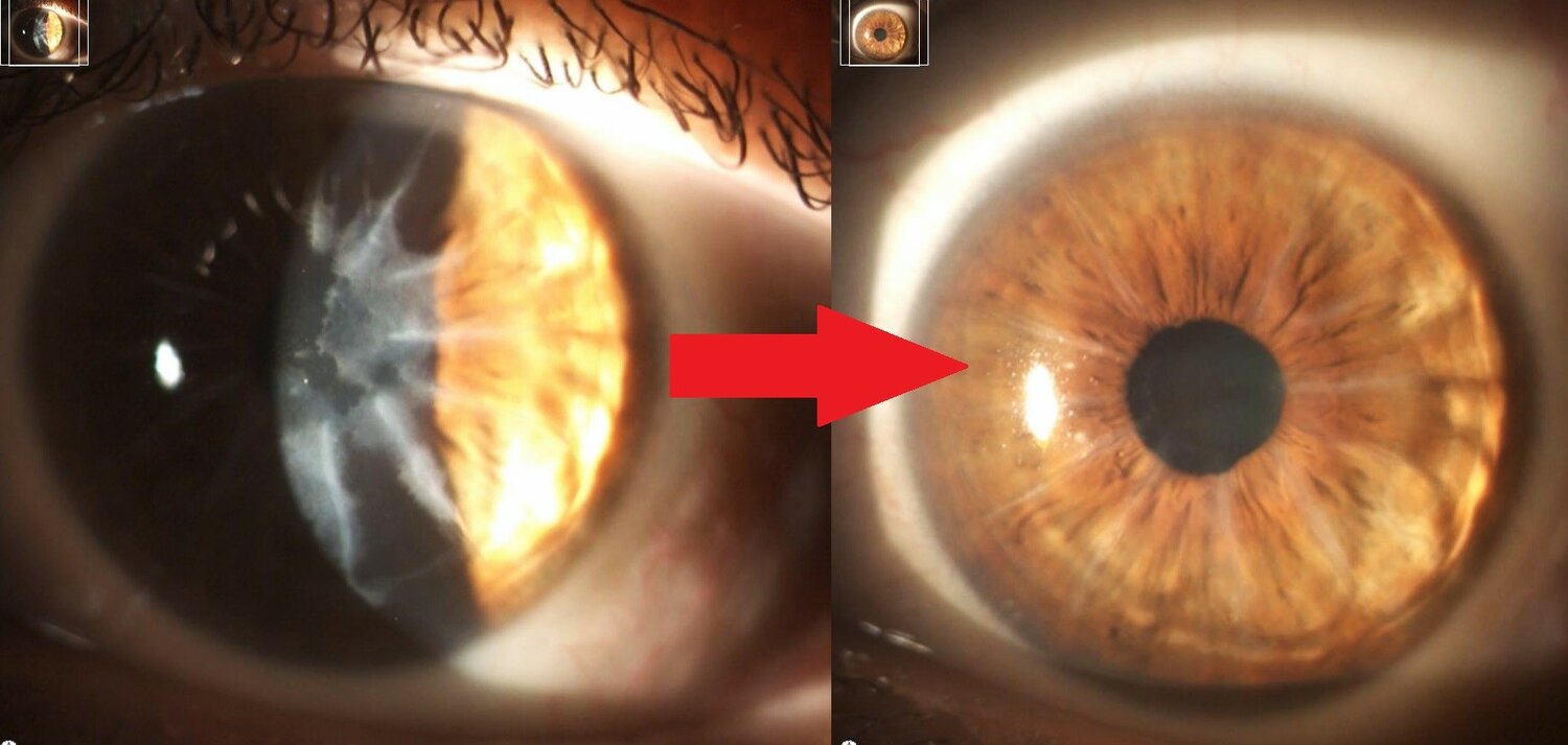 Before and after photos of a repaired cornea using LaZrPlastique.