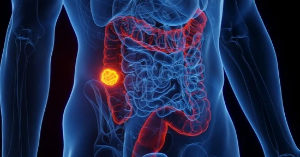 USF Health, Tampa General study finds metastatic colorectal cancer’s immune defenses may begin outside the cancer cell, challenging view held for decades