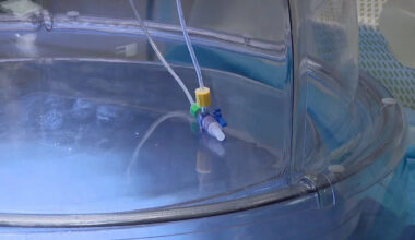 Tampa General lung transplants: New technology tests donor organ performance