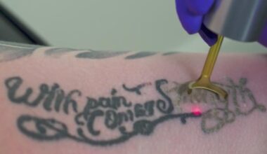 From exes' names to old designs, 30 to 40 South Florida clients a week pay to erase tattoos, clinic says