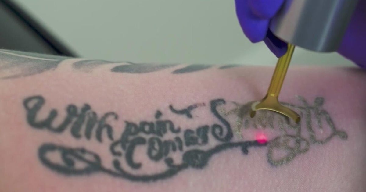 From exes' names to old designs, 30 to 40 South Florida clients a week pay to erase tattoos, clinic says