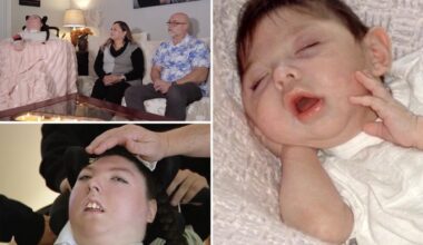 Woman born with no brain turns 20 in medical 'miracle'