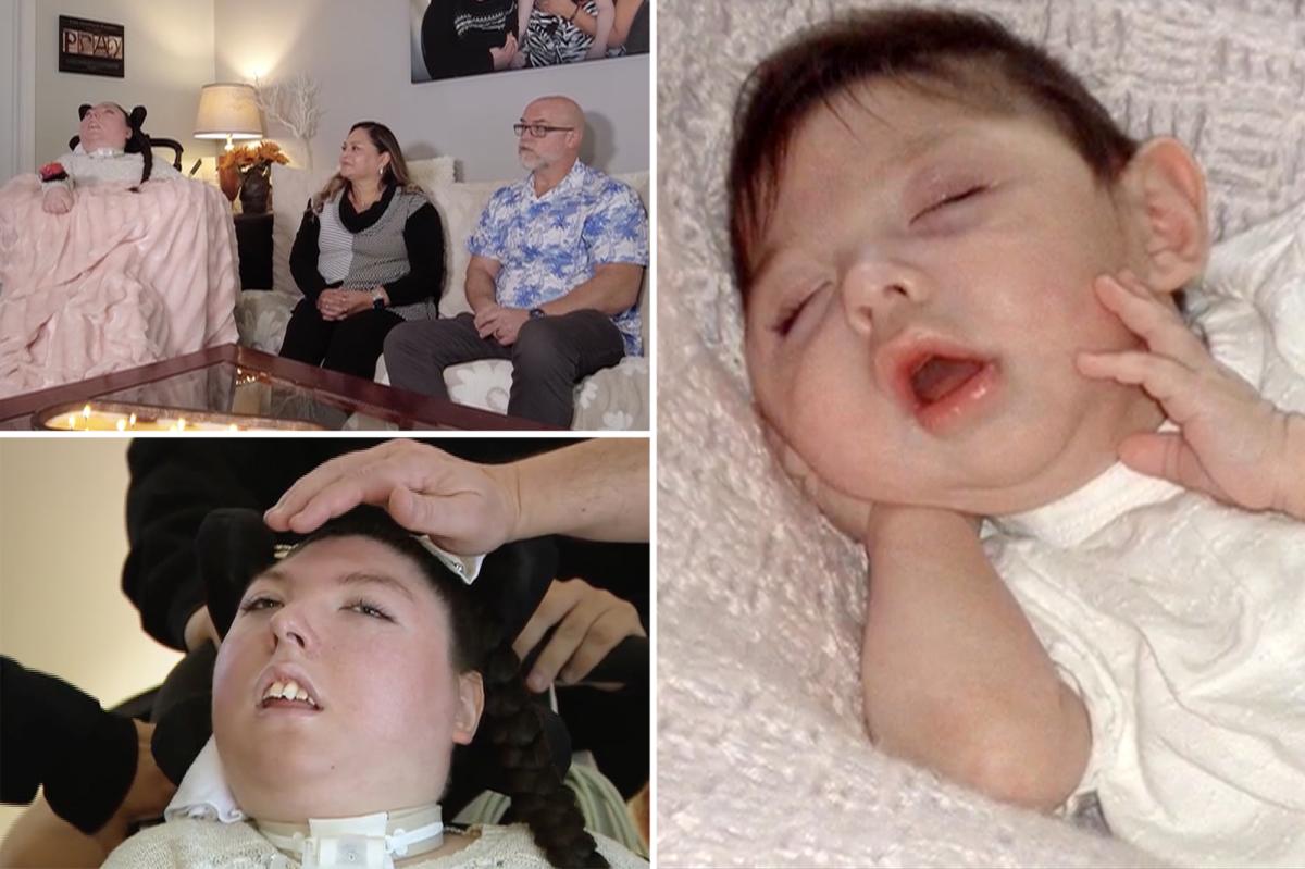 Woman born with no brain turns 20 in medical 'miracle'