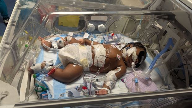 Dhruvan soon after transplant.