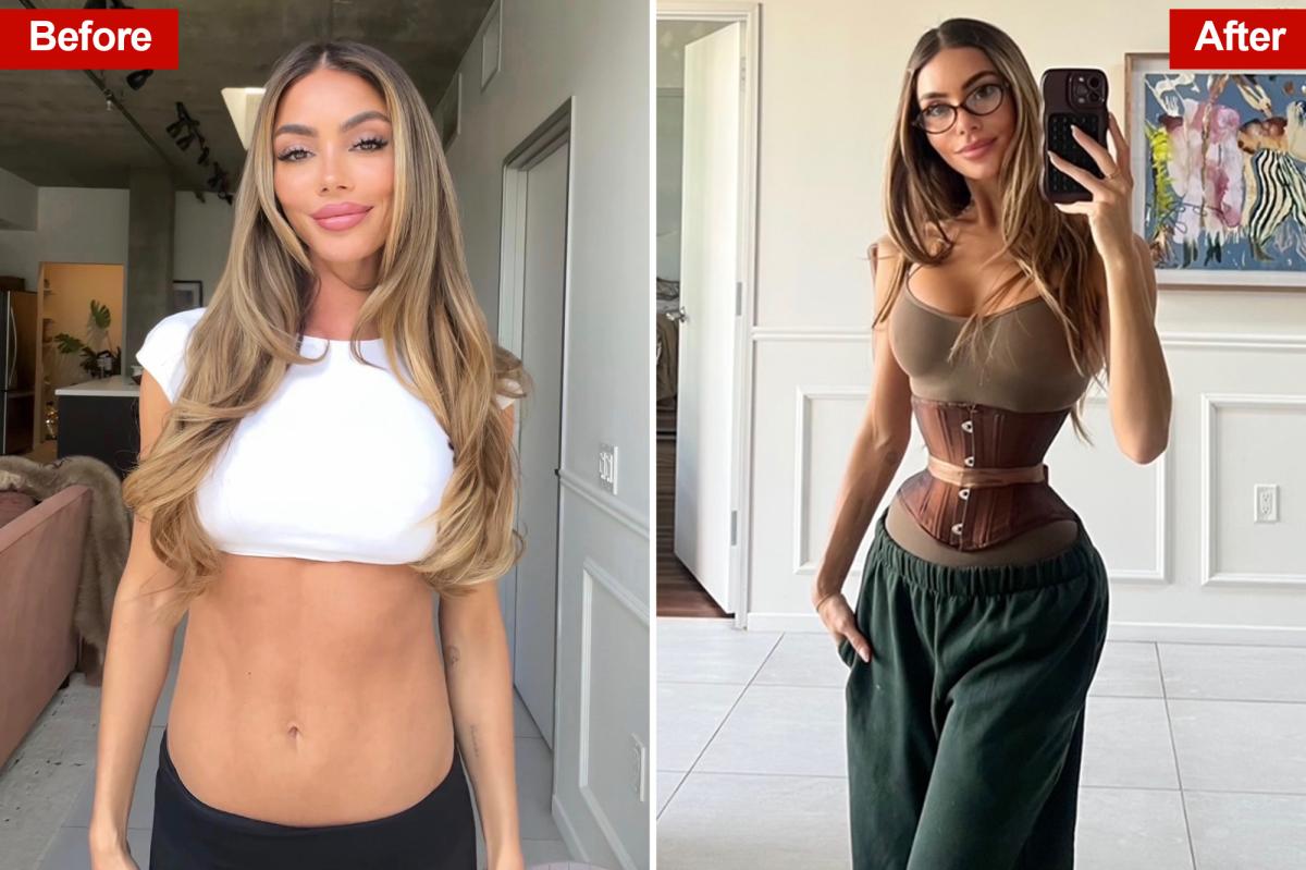 Exclusive | Rib remodeling surgery gaining in popularity amid risky 'Ozempic body' trend