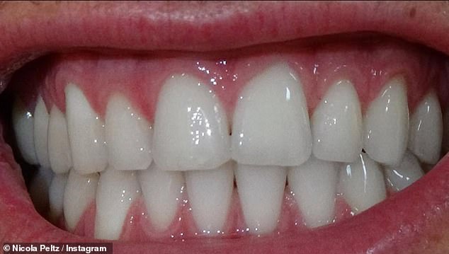 Dr Mervyn Druian of The London Centre for Cosmetic Dentistry agreed there has been a change in her teeth since this photo of them taken in 2020