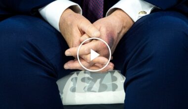 Trump Links Bruise on Hand to Aspirin