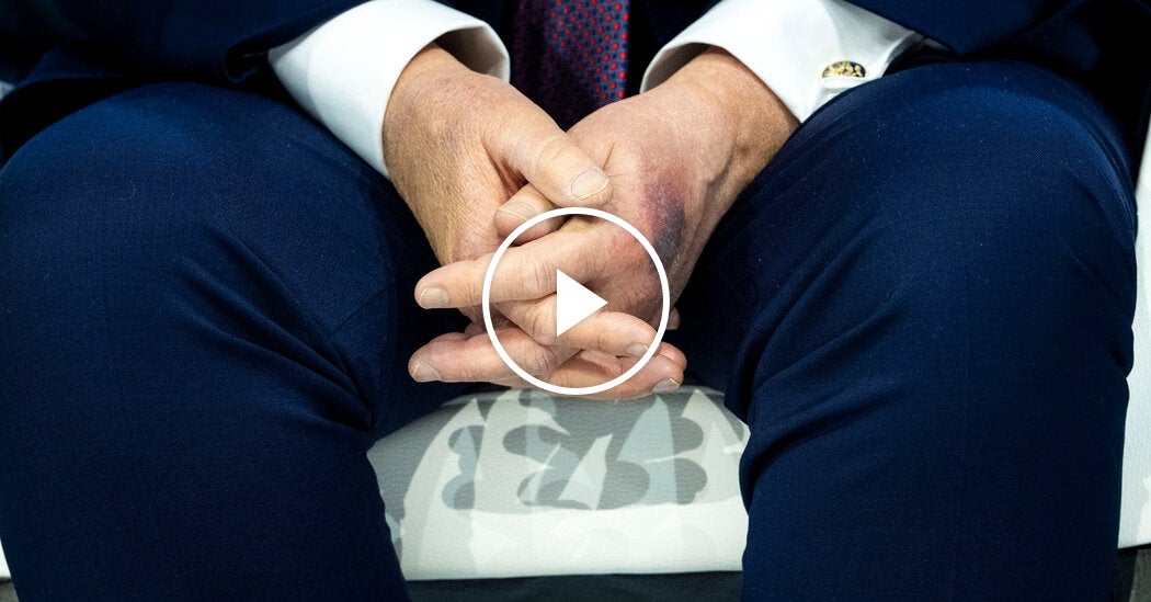 Trump Links Bruise on Hand to Aspirin