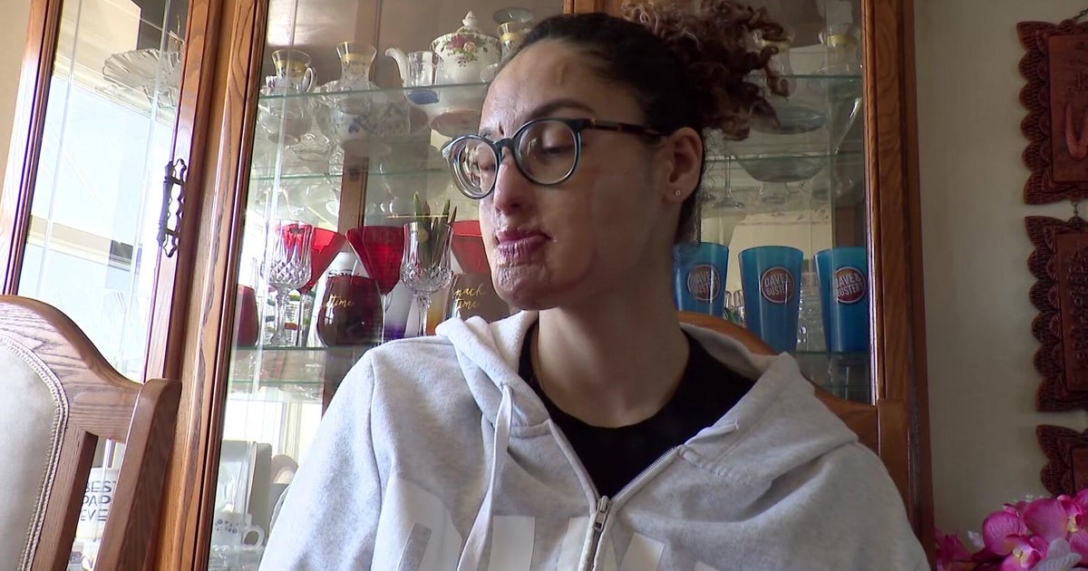 Arrest made in 2021 Long Island acid attack that left woman disfigured, sources say