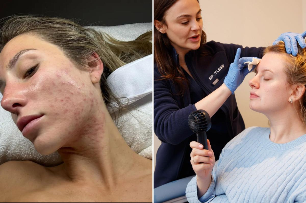 NYC's CityMD for quick-fix, on-your-lunch-break acne treatments