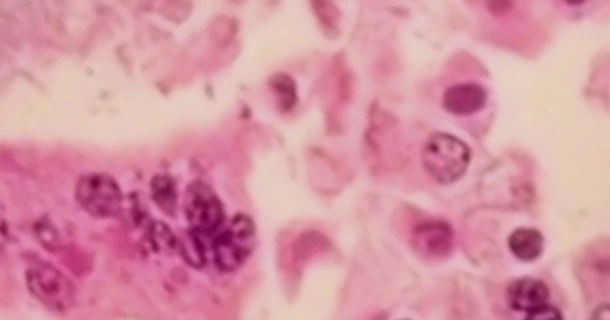 Measles in Nassau County: What to know