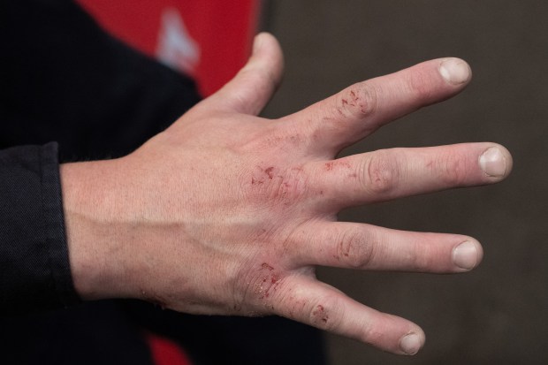 FDNY firefighter Travis Langan shows his injured hand from breaking the sunroof of Carmen Pinto's vehicle during a press conference at FDNY headquarters Friday, May 22, 2026 in Brooklyn, New York. (Barry Williams/ New York Daily News)