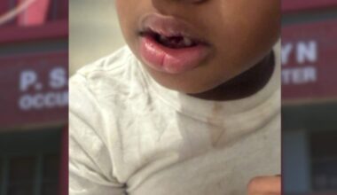 Mom demands answers after son with autism returns from school with missing teeth, bloody shirt