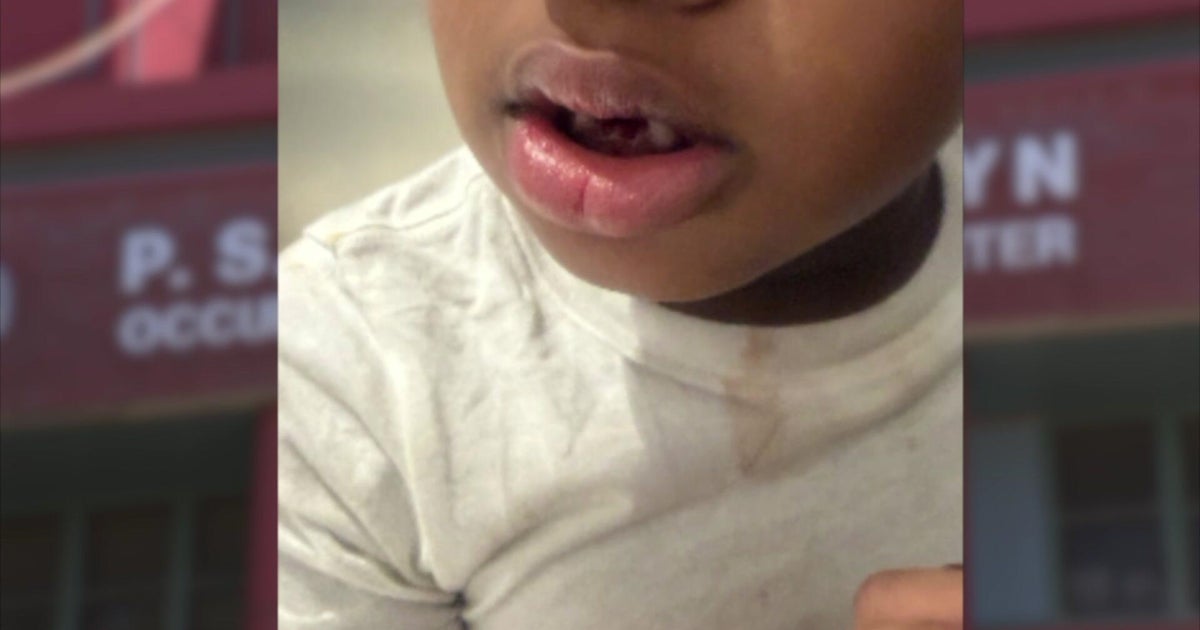 Mom demands answers after son with autism returns from school with missing teeth, bloody shirt