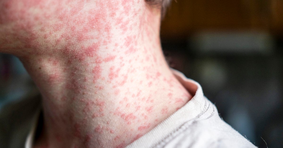 Confirmed case of measles in Manhattan, NYC DOH says