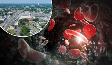 Long Island has 'high burden' for common blood disorder: study