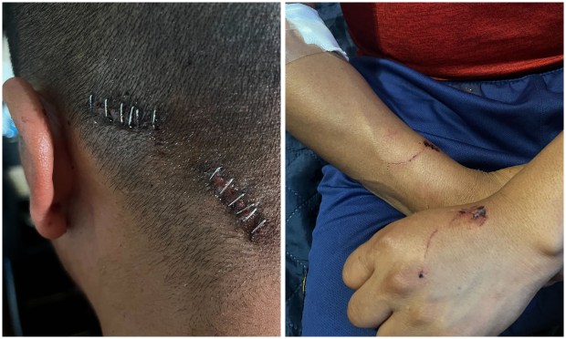 The occupant of an apartment on Avenue D in Flatbush shows injuries sustained after he confronted a burglar in his home on Friday night.